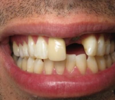 Teeth before bridge procedure