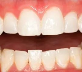 Teeth after teeth whitening procedure