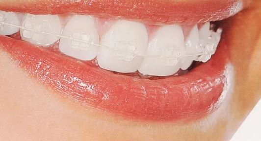 Picture of porcelain braces