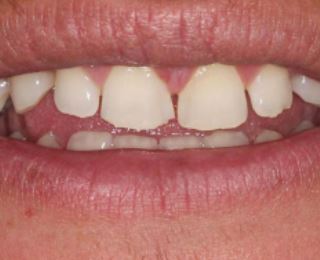 Teeth before Porcelain Veneers Procedure