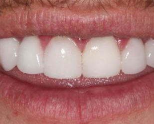 Teeth after Porcelain Veneers Procedure
