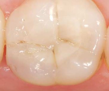 Patient teeth after tooth colored filling
