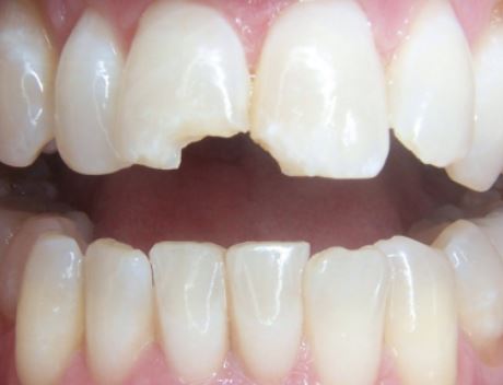 Teeth before dental crown procedure