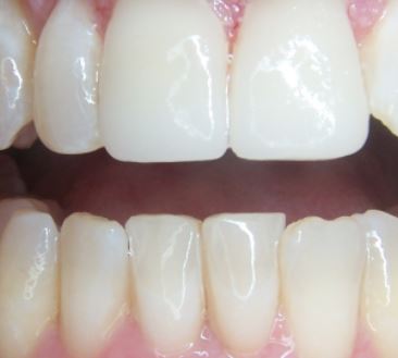 Teeth after dental crown procedure