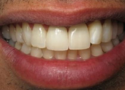 Teeth after bridge procedure