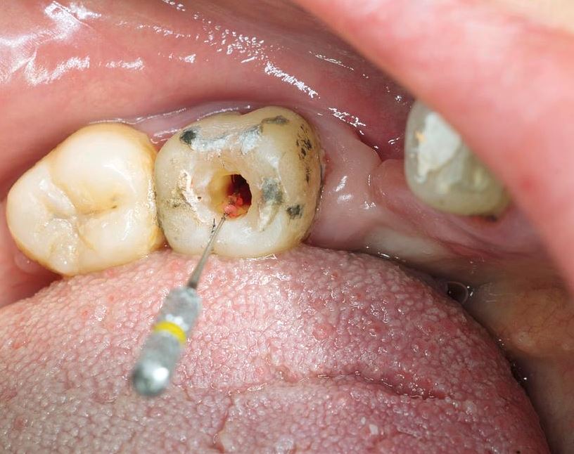 Root canal treatment