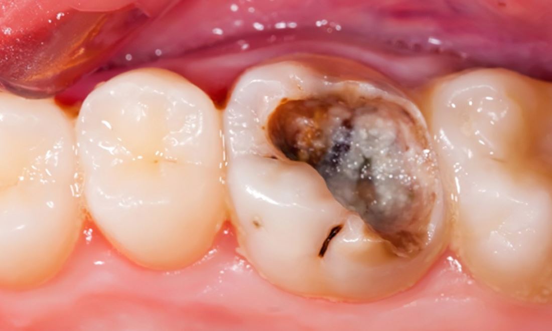 Tooth damage showing signs of needed root canal