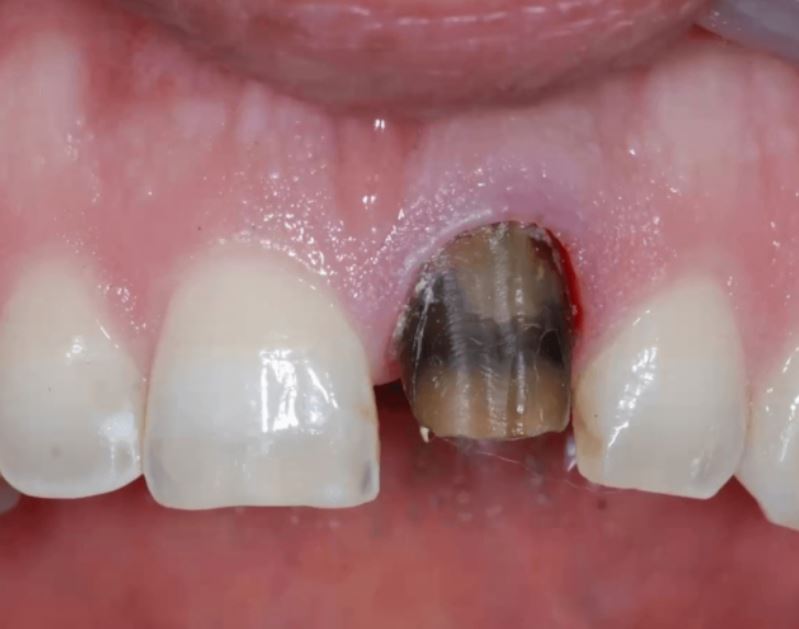 Tooth damage showing signs of needed root canal