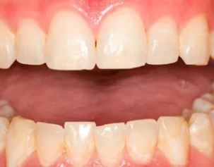 Teeth before teeth whitening procedure